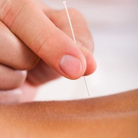 A person is using acupuncture needles to treat an illness.