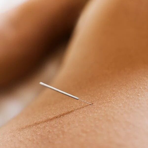 A close up of an acupuncture needle on the back of a woman 's body.